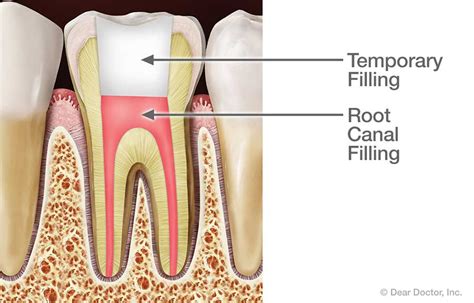 Root Canal Treatment | Glen Ellyn