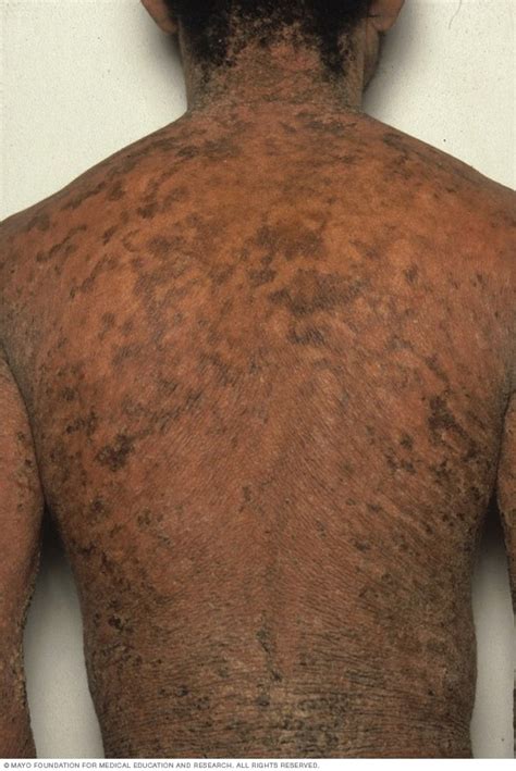 Ichthyosis vulgaris - Mayo Clinic