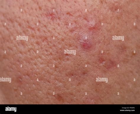 closeup skin problems, nodular cystic acne skin Stock Photo - Alamy