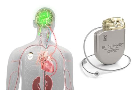 Barostim Therapy: Revolutionizing Hypertension Treatment - Patient9.com