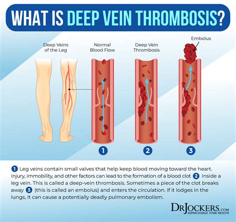 Deep Vein Thrombosis Dvt Symptoms And Risk Factors He - vrogue.co