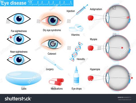 Injection Into Eye: Over 6,644 Royalty-Free Licensable Stock Vectors ...