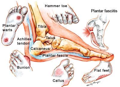 Foot Problems - Plantar Fasciitis Treated via Chiropractic