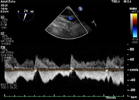 Pulse wave Doppler suggesting venous flow | Download Scientific Diagram