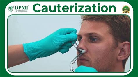 Cauterization: What Is Cauterization Used For? Cauterization Procedure ...