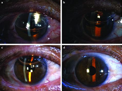 Images of the right eye of a patient with air bubble given at the end... | Download Scientific ...