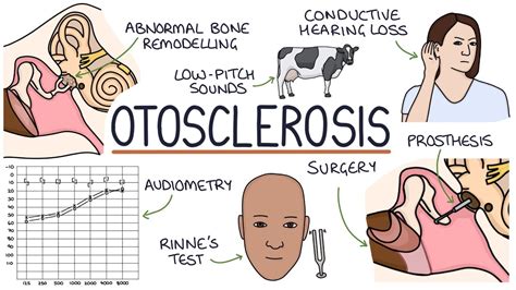 Understanding Otosclerosis - YouTube