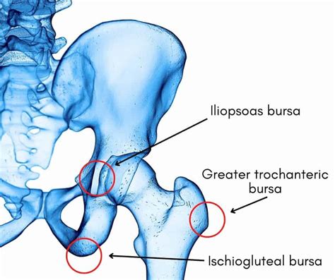 Hip Bursitis: Symptoms, Causes and Best Exercises for Pain Relief