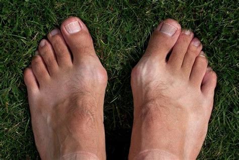 The Real Cause of Bunions, and Their Treatment | Articles | Toe Salad