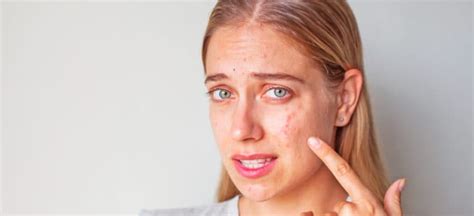 Nodular Acne Symptoms, Causes, Treatments and More - Dr. Axe