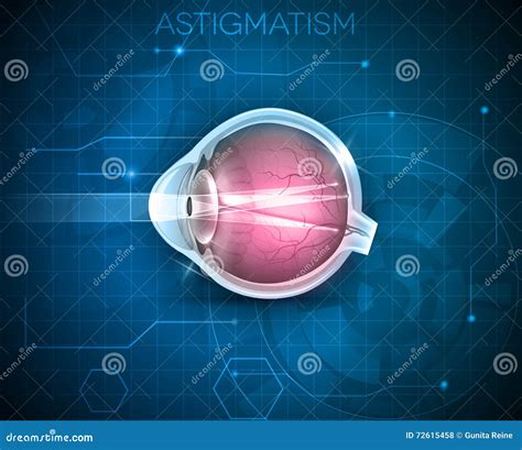 Astigmatism, Eyesight Problem Stock Vector - Illustration of design, medicine: 72615458