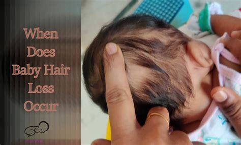 Baby hair loss: How To Solve | FIRST WALK | Baby Hair