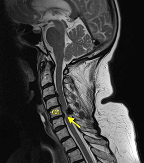 Cervical myelopathy - MRI - Radiology at St. Vincent's University Hospital