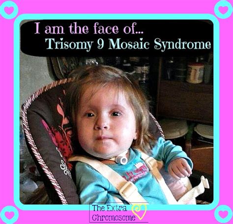 The Extra Chromosome: Trisomy 9 Mosaic