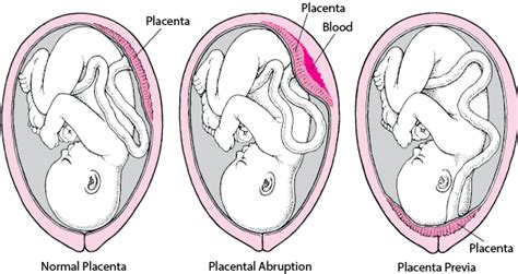 Placental Abruption - Women's Health Issues - MSD Manual Consumer Version