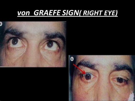 von GRAEFE SIGN( RIGHT EYE) - www.medicoapps.org