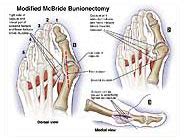 Modified McBride Bunionectomy Medical Exhibit