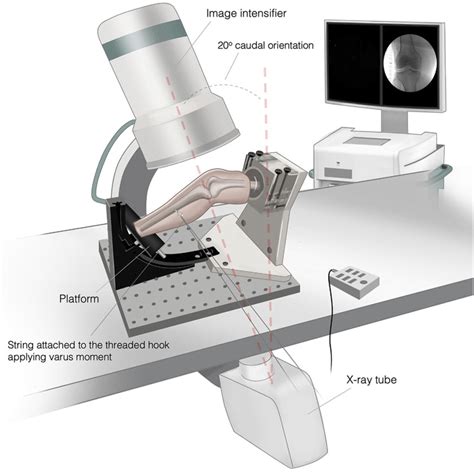 Illustration demonstrating a medial view of the varus stress testing ...