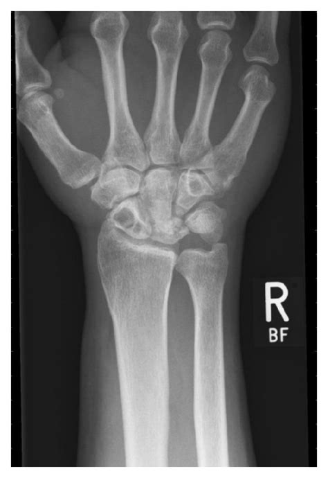 Bone Cyst Hand X Ray