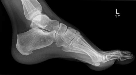 X-rays Of Bone Spurs On Foot Hot Sale | emergencydentistry.com