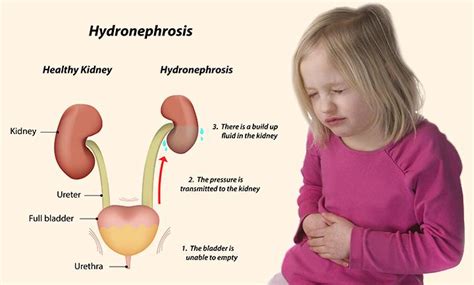 Hydronephrosis In Children - Causes, Symptoms And Treatment