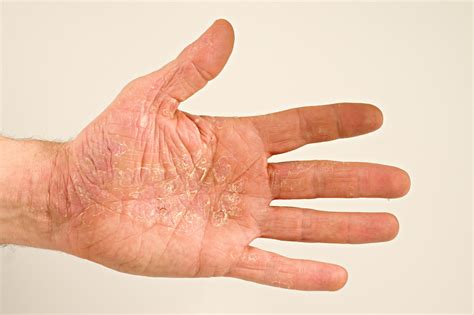 5 Ways To Manage Your Hand Eczema