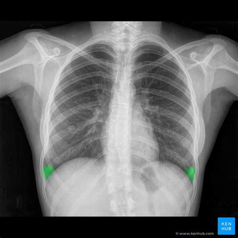 Neat How To Report Normal Chest X Ray Write A Good Introduction For Research