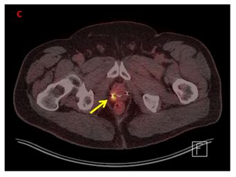 PET/CT for Prostate Cancer: From Diagnosis to Metastasis - Renal and ...