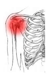 Adhesive Capsulitis - Signs & Symptoms