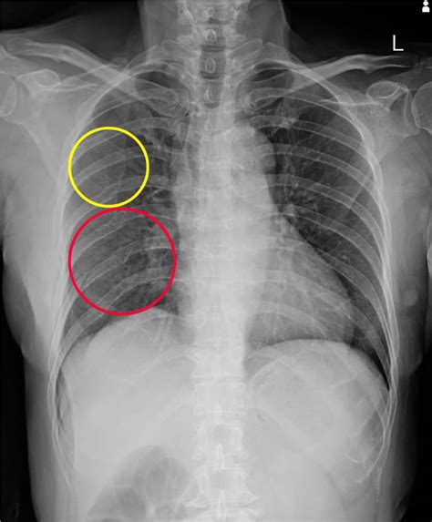 Rib Fracture & Fixation from Trauma - International Centre For Thoracic ...