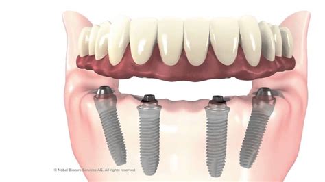 Prothèse clipsée sur implant et sur dent – Smile Zentrum Zahnklinik