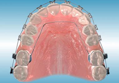 Stanley Orthodontics Describes Orthodontic Appliances