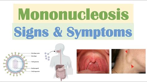 Infectious Mononucleosis (Mono) Signs & Symptoms - YouTube