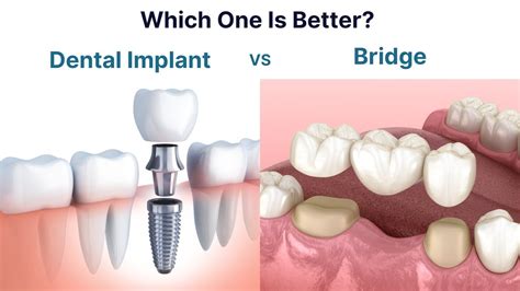 Dental Bridges Vs Implants