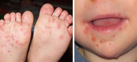 Hand Foot And Mouth Disease Is Sweeping Across Parts Of The US