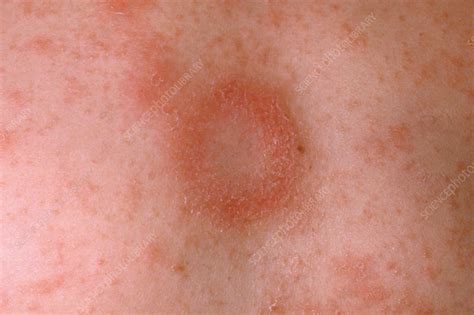 Pityriasis rosea rash - Stock Image - C050/0827 - Science Photo Library