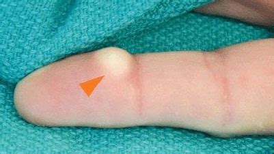 What Causes Lump to Appear in Your Palm? | Med-Health.net