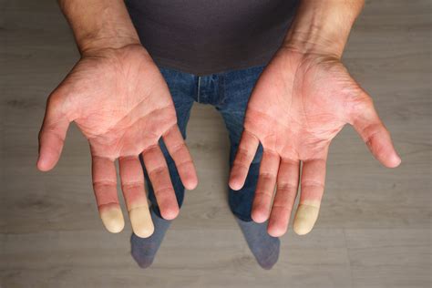 What is Raynaud’s Phenomenon?