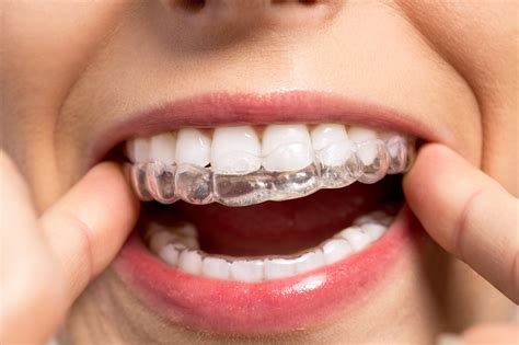 Tips for Cleaning Your Invisalign Aligners | Bracify 3D Orthodontics