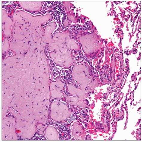 Epithelioid Hemangioendothelioma | Basicmedical Key