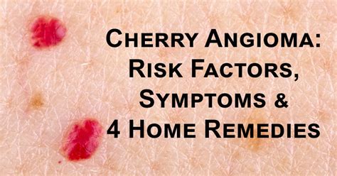 Cherry Angioma: Risk Factors, Symptoms & 4 Home Remedies - DavidWolfe.com