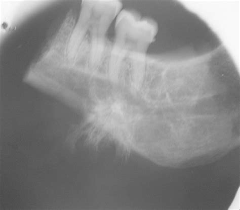 Osteogenic Sarcoma Sunburst