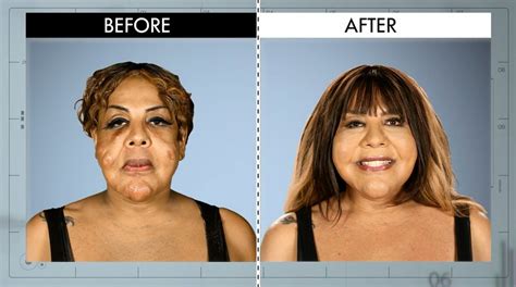 Concrete in Her Face from Botched Patients Before and After—Shocking ...