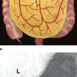 (PDF) Pelvic Reconstruction with Omental and VRAM Flaps: Anatomy, Surgical Technique, Normal ...