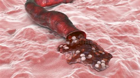 Blood flow, hemorrhage stock illustration. Illustration of microbiology ...