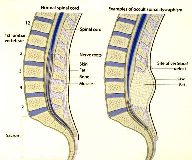 Diagnosing And Treating A Tethered Spinal Cord | Pediatric Neurosurgery