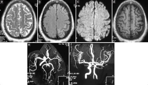 T2-weighted image (a) showing few scattered T2 hyperintense foci in the... | Download Scientific ...