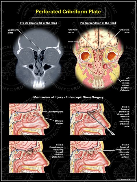 Perforated Cribriform Plate