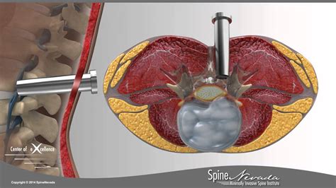 Lumbar Microdiscectomy - Spine Center Northern Nevada, Northern ...