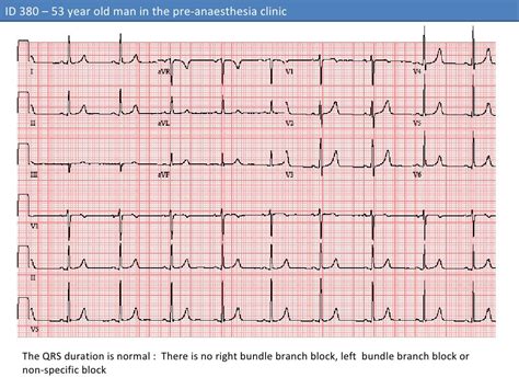 ECG #1 - ID 380 – Normal ECG